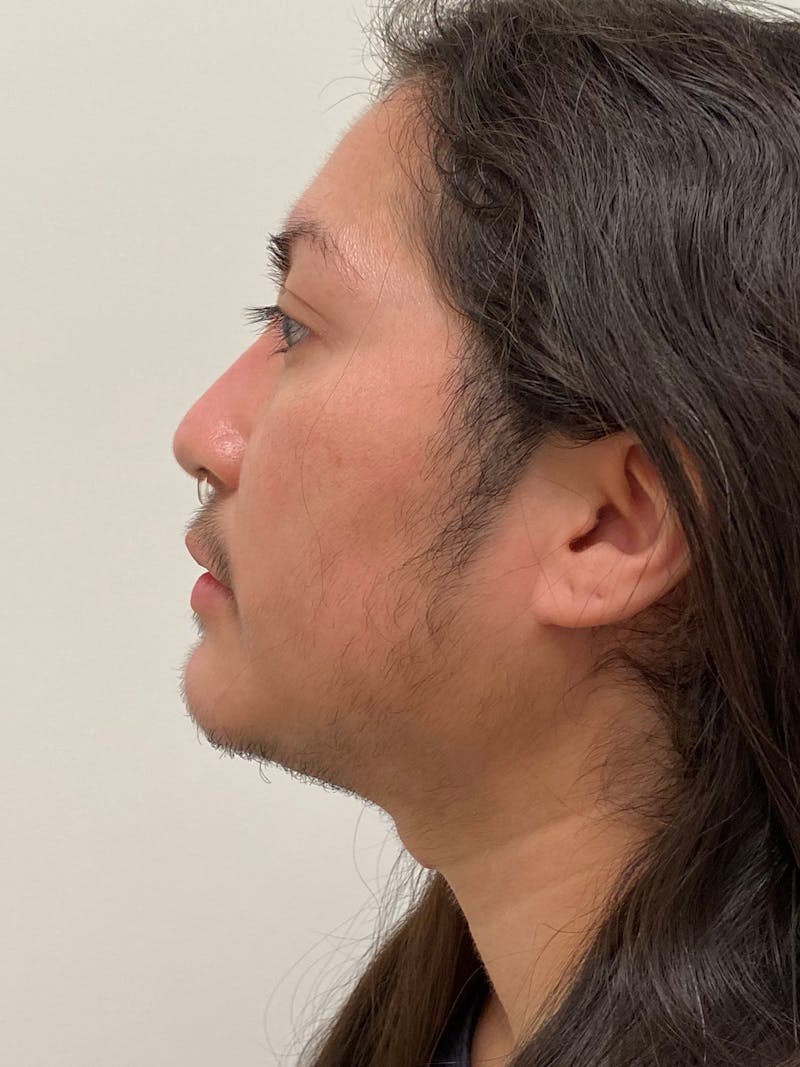 Facial Masculinization Before & After Gallery - Patient 119547 - Image 8