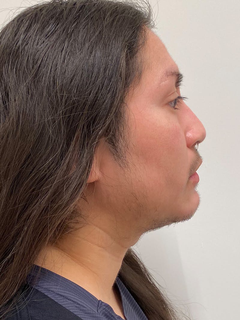 Facial Masculinization Before & After Gallery - Patient 119547 - Image 6