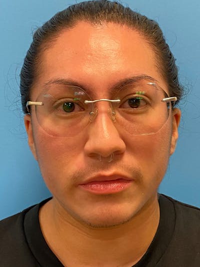 Facial Masculinization Before & After Gallery - Patient 119547 - Image 1