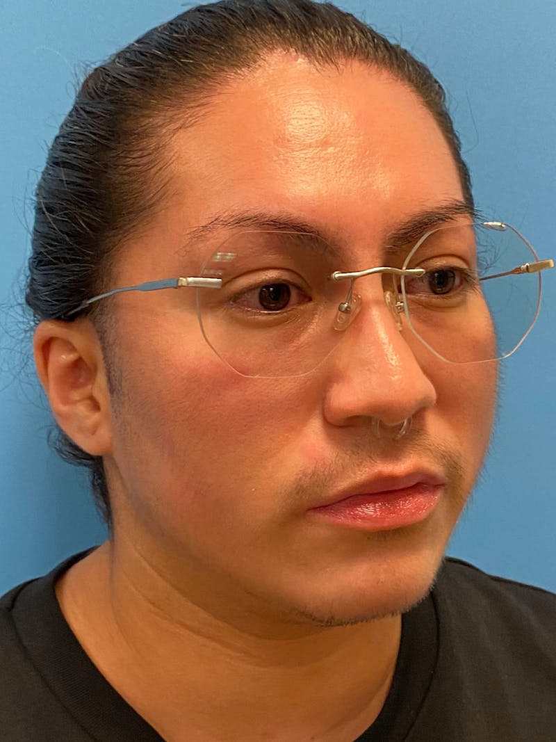 Facial Masculinization Before & After Gallery - Patient 119547 - Image 3