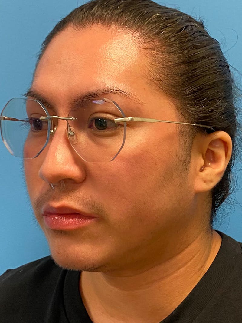 Facial Masculinization Before & After Gallery - Patient 119547 - Image 9