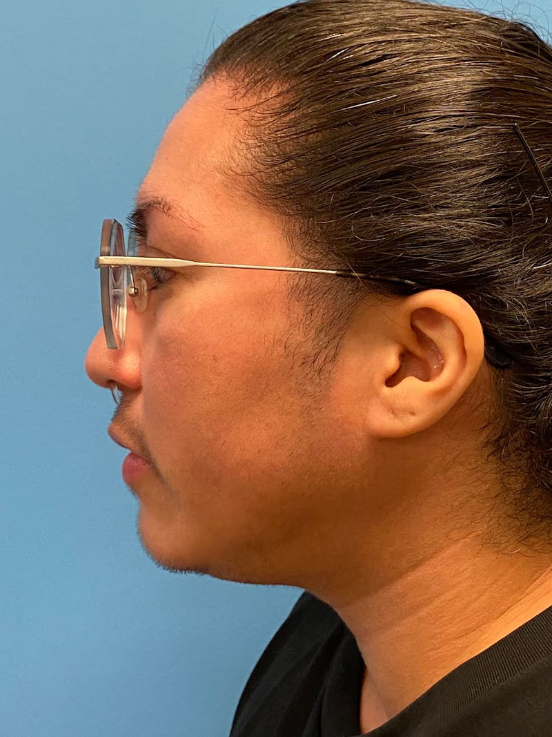 Facial Masculinization Before & After Gallery - Patient 119547 - Image 7