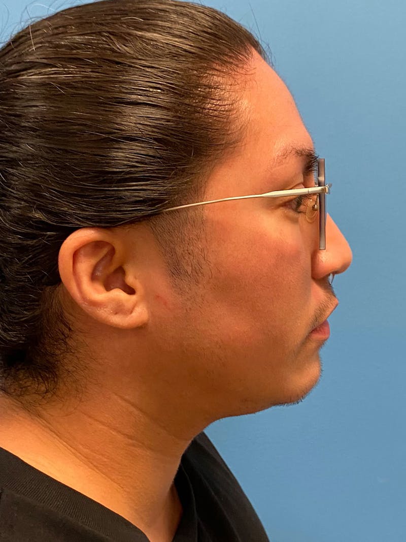 Facial Masculinization Before & After Gallery - Patient 119547 - Image 5