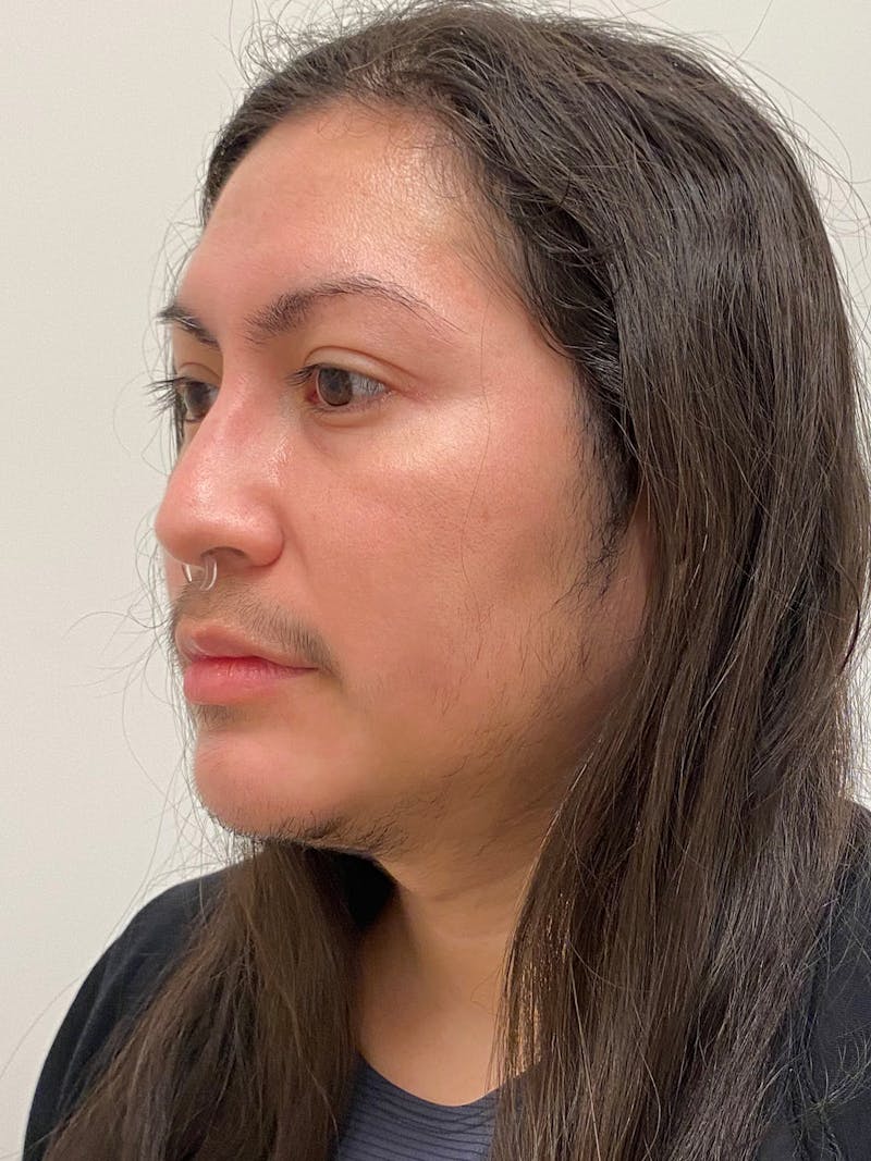 Facial Masculinization Before & After Gallery - Patient 119547 - Image 10