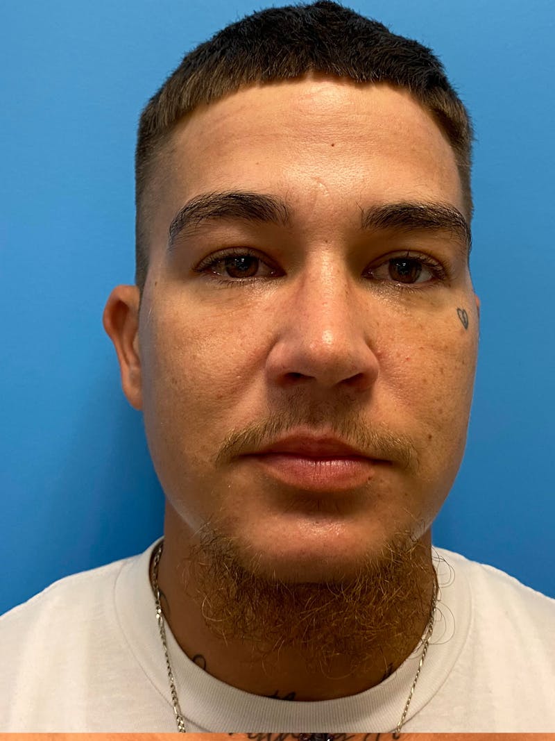 Facial Masculinization Before & After Gallery - Patient 230201 - Image 2