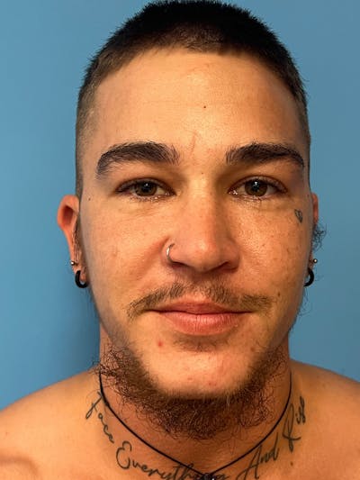 Facial Masculinization Before & After Gallery - Patient 230201 - Image 1