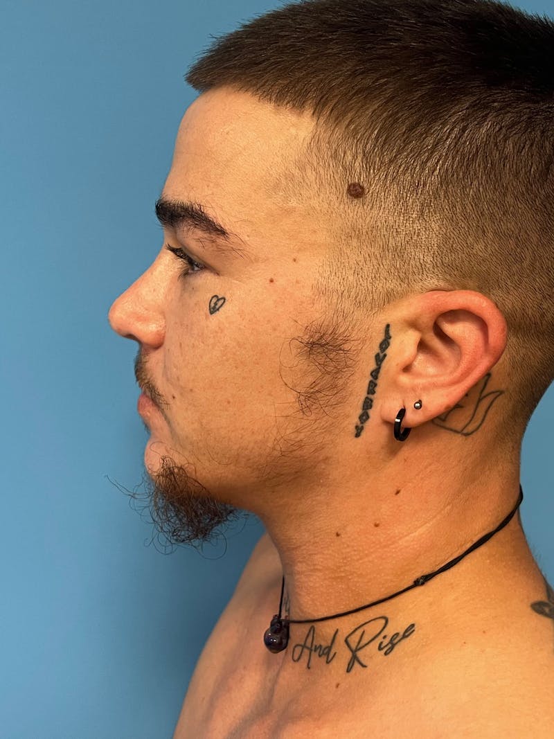 Facial Masculinization Before & After Gallery - Patient 230201 - Image 5