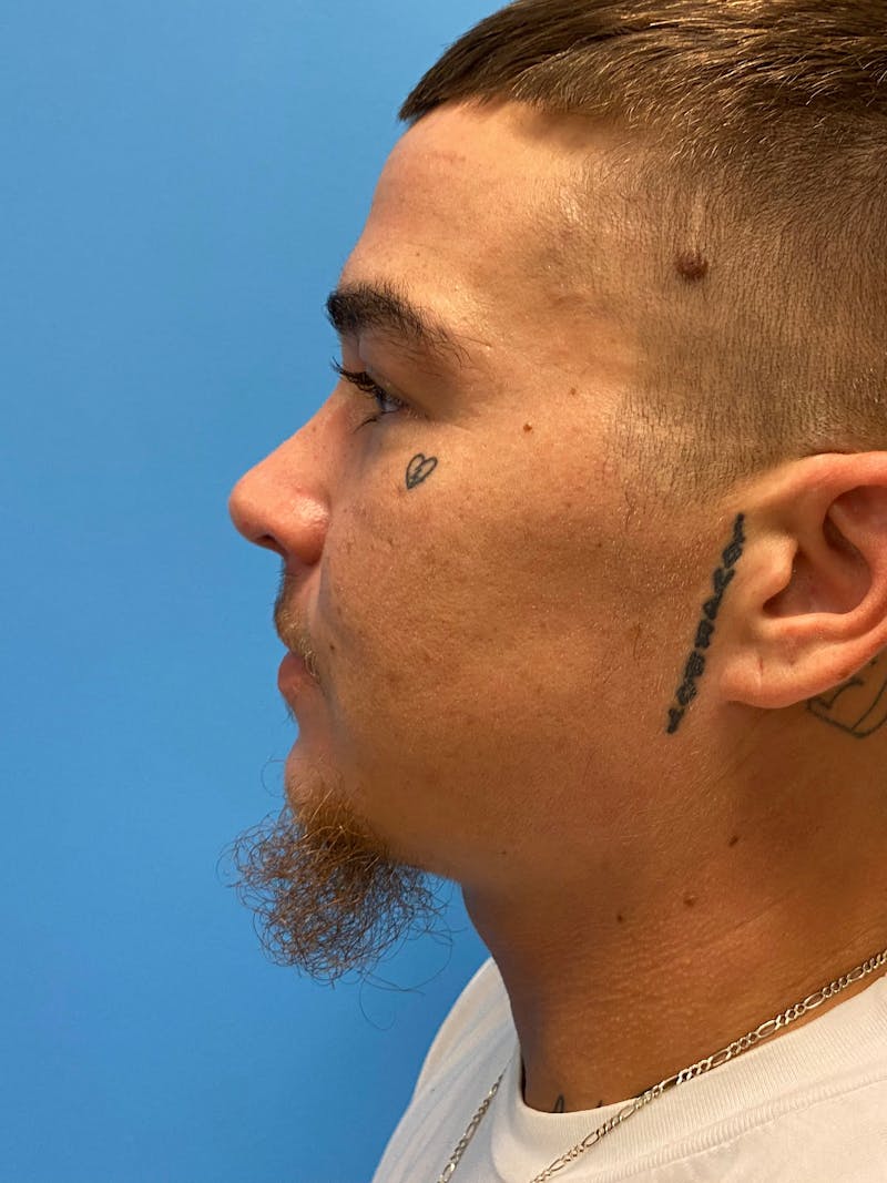 Facial Masculinization Before & After Gallery - Patient 230201 - Image 6