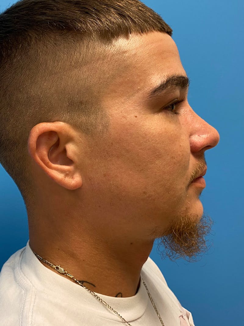 Facial Masculinization Before & After Gallery - Patient 230201 - Image 4