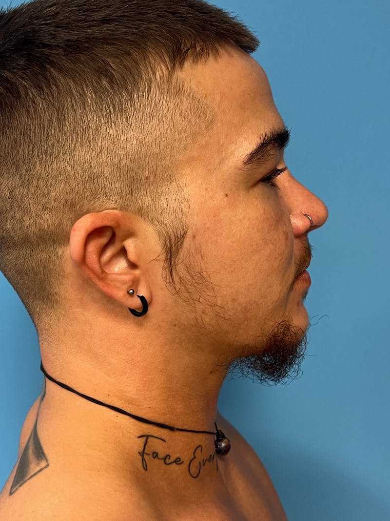 Facial Masculinization Before & After Gallery - Patient 230201 - Image 3