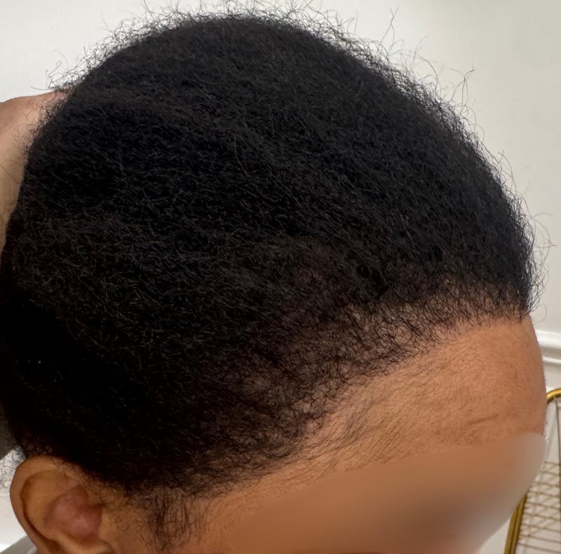 Hair Transplant Before & After Gallery - Patient 157223 - Image 2