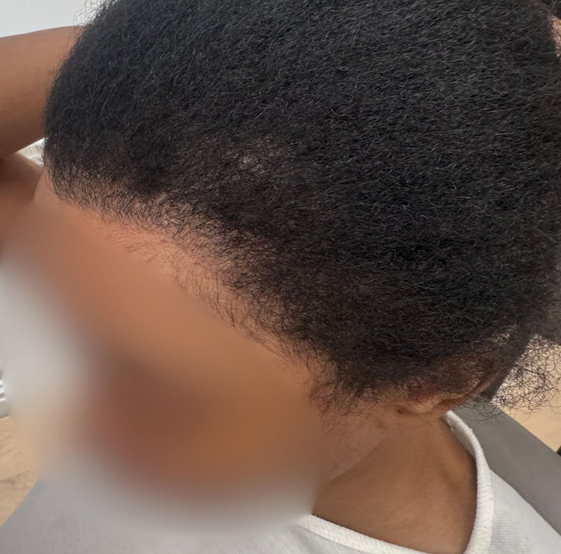 Hair Transplant Before & After Gallery - Patient 157223 - Image 4