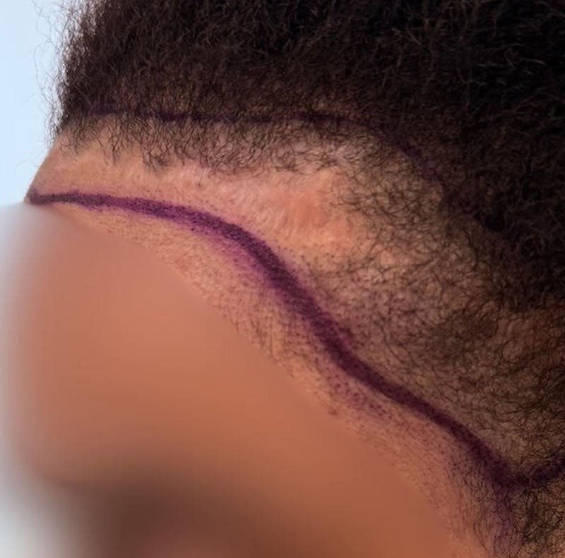 Hair Transplant Before & After Gallery - Patient 157223 - Image 3