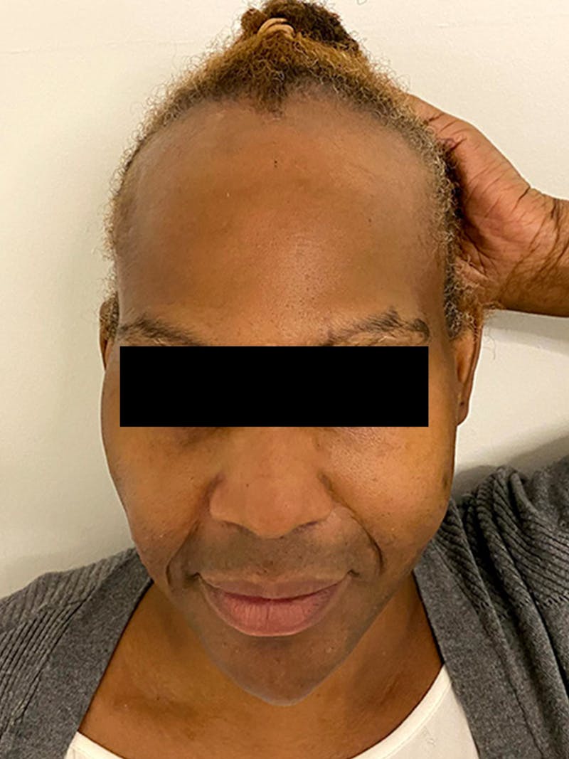 Hair Transplant Before & After Gallery - Patient 393678 - Image 1