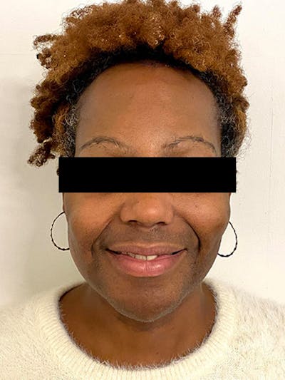 Hair Transplant Before & After Gallery - Patient 393678 - Image 2