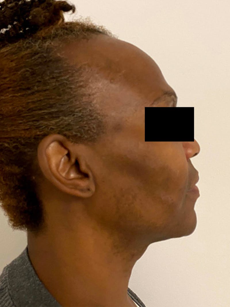 Hair Transplant Before & After Gallery - Patient 393678 - Image 3