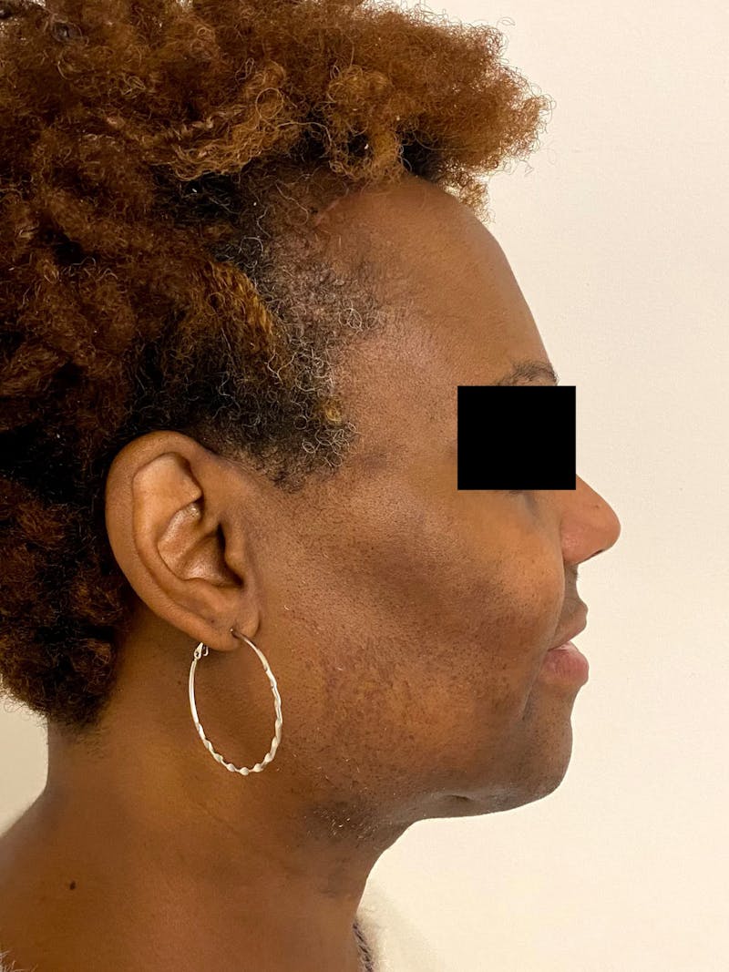 Hair Transplant Before & After Gallery - Patient 393678 - Image 4
