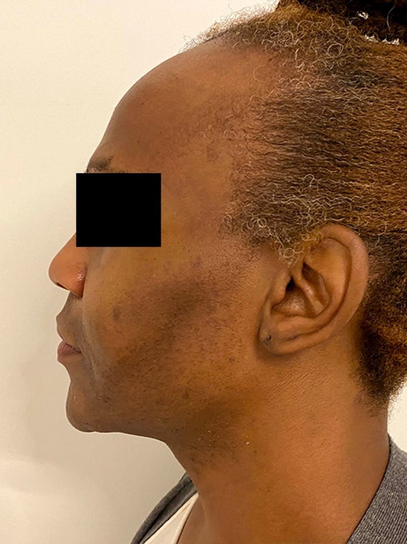 Case Studies Before & After Gallery - Patient 347232 - Image 5