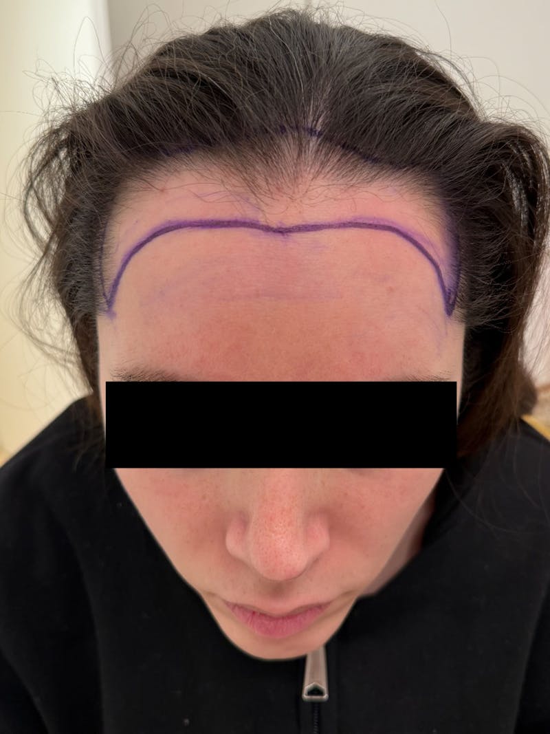 Hair Transplant Before & After Gallery - Patient 365926 - Image 1