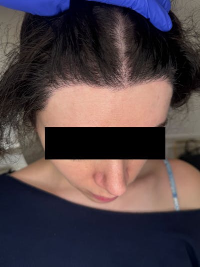 Hair Transplant Before & After Gallery - Patient 365926 - Image 2