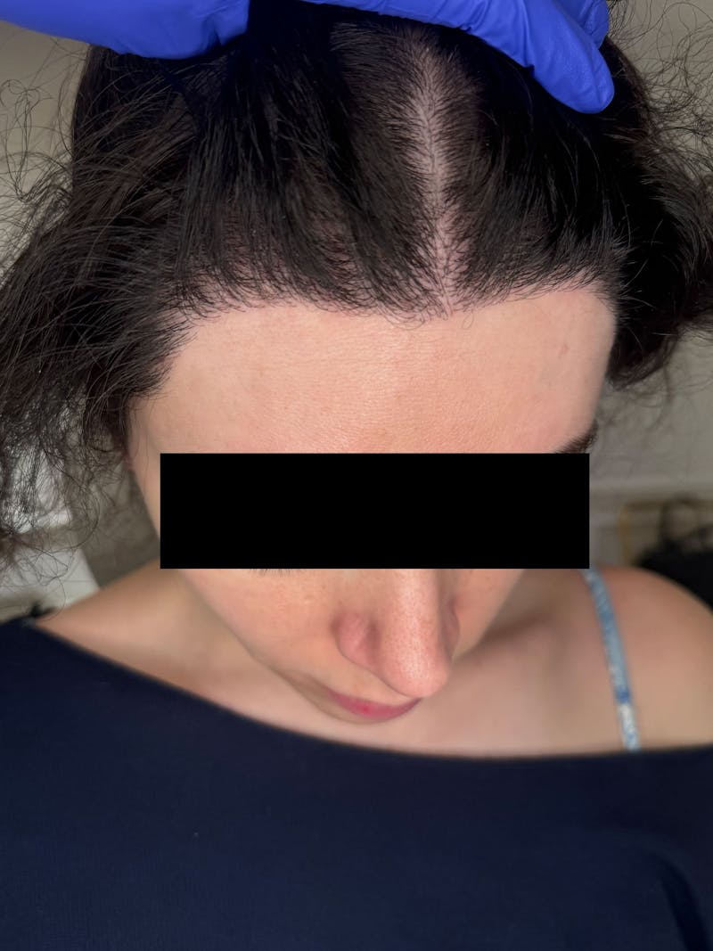 Hair Transplant Before & After Gallery - Patient 365926 - Image 2