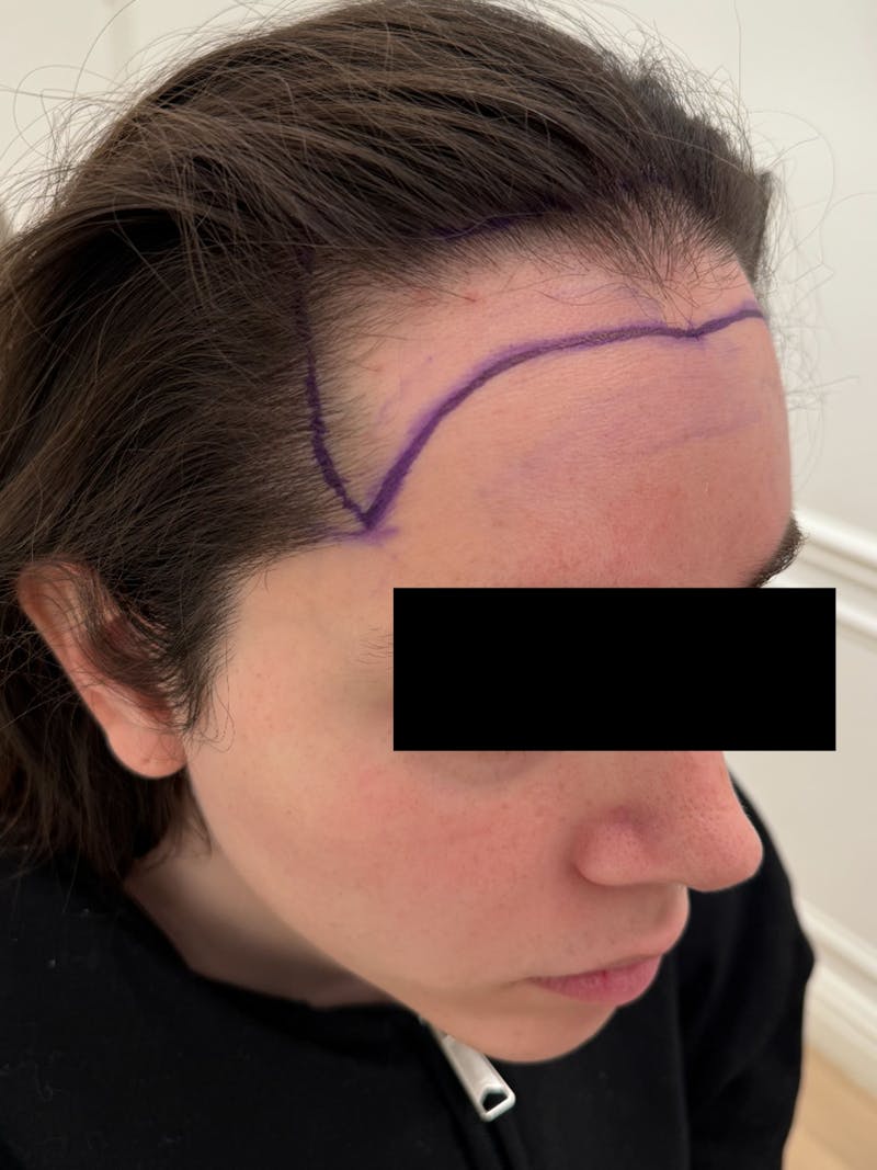 Hair Transplant Before & After Gallery - Patient 365926 - Image 3