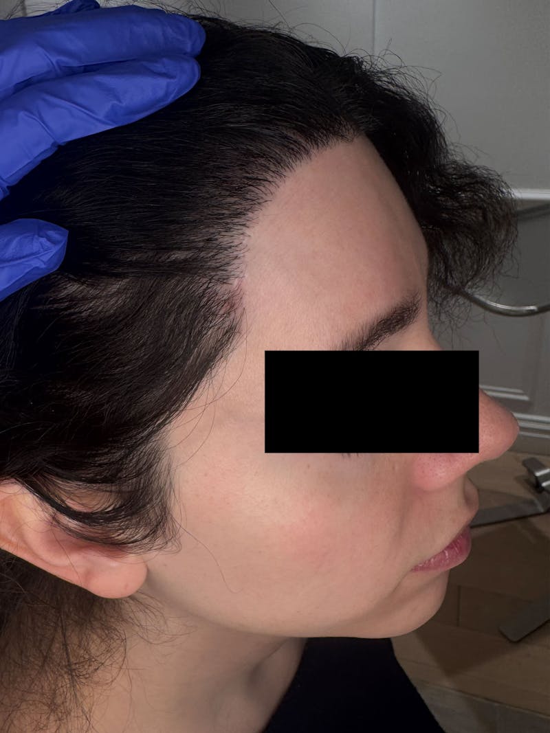 Hair Transplant Before & After Gallery - Patient 365926 - Image 4