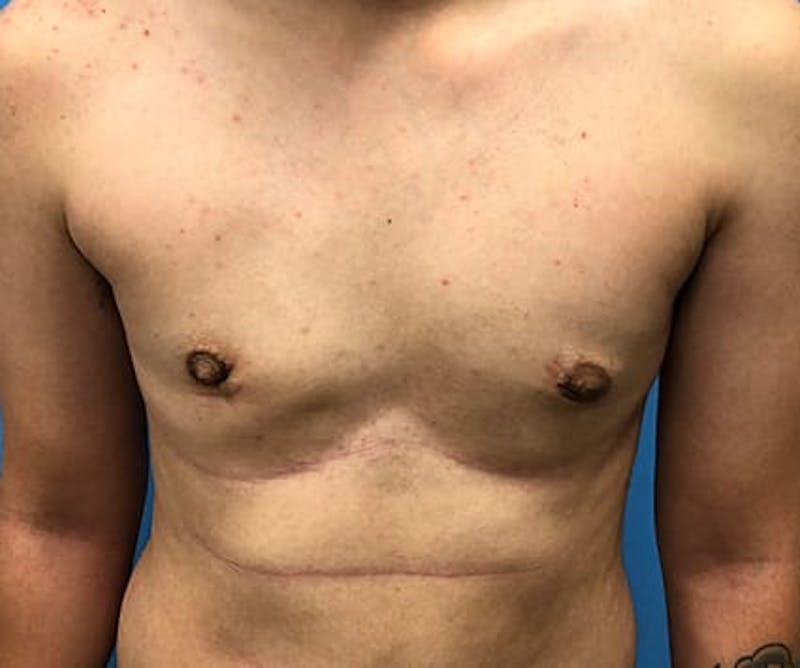 Chest Masculinization Before & After Gallery - Patient 206977 - Image 2