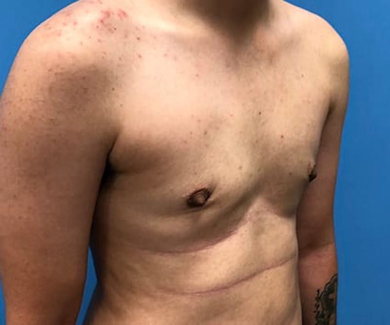 Chest Masculinization Before & After Gallery - Patient 206977 - Image 6