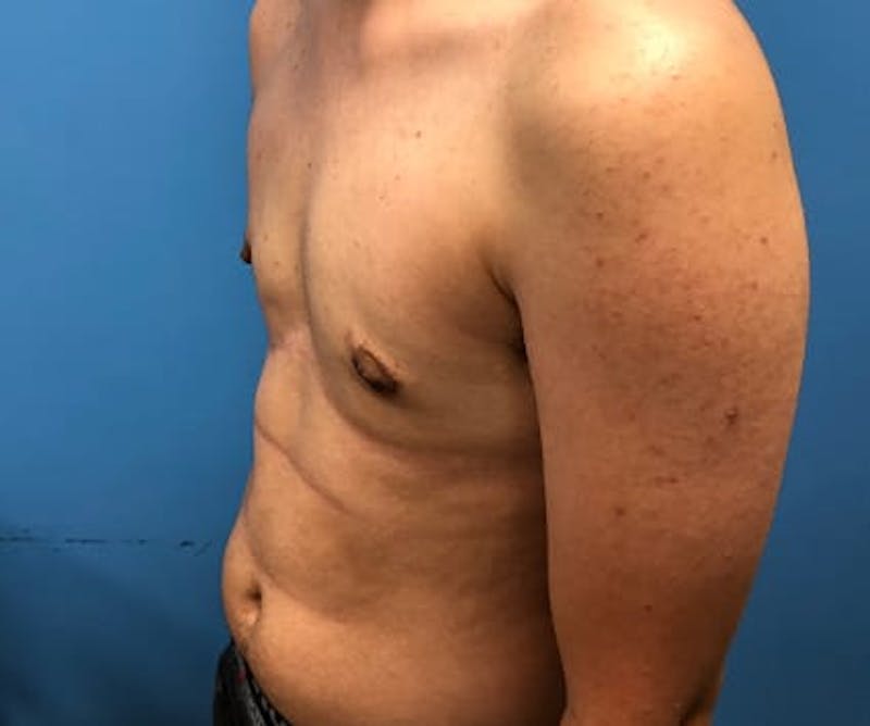 Chest Masculinization Before & After Gallery - Patient 206977 - Image 4