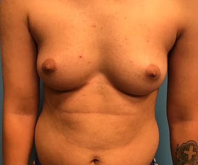 Chest Masculinization Before & After Gallery - Patient 206977 - Image 1