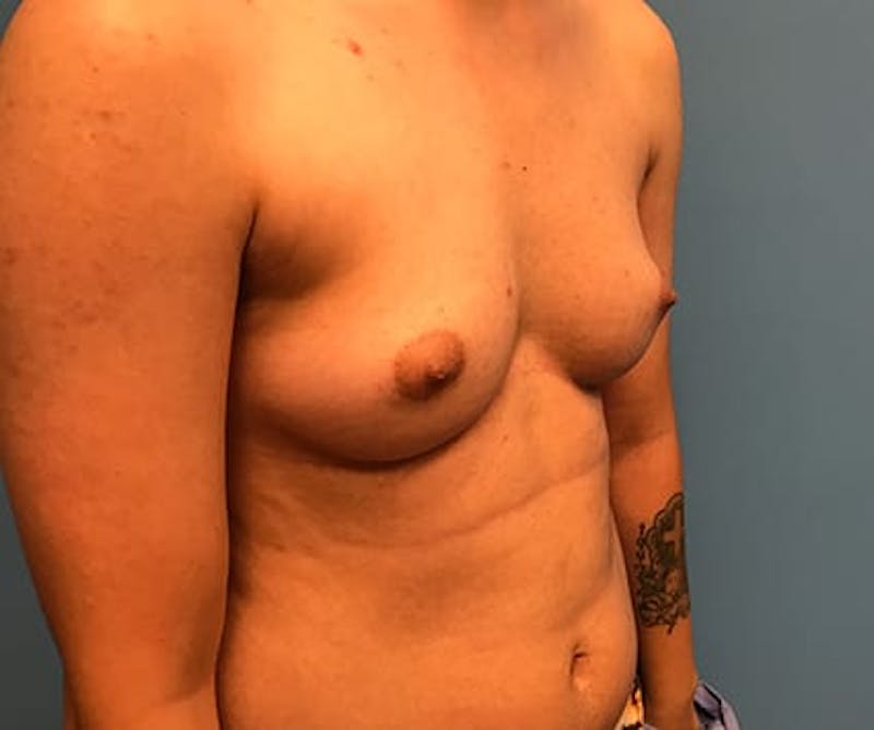 Chest Masculinization Before & After Gallery - Patient 206977 - Image 5