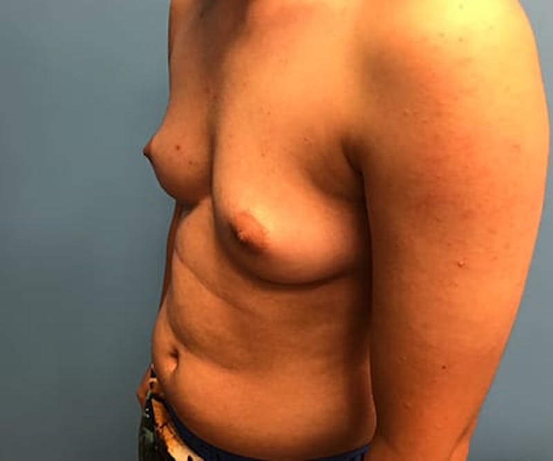 Chest Masculinization Before & After Gallery - Patient 206977 - Image 3