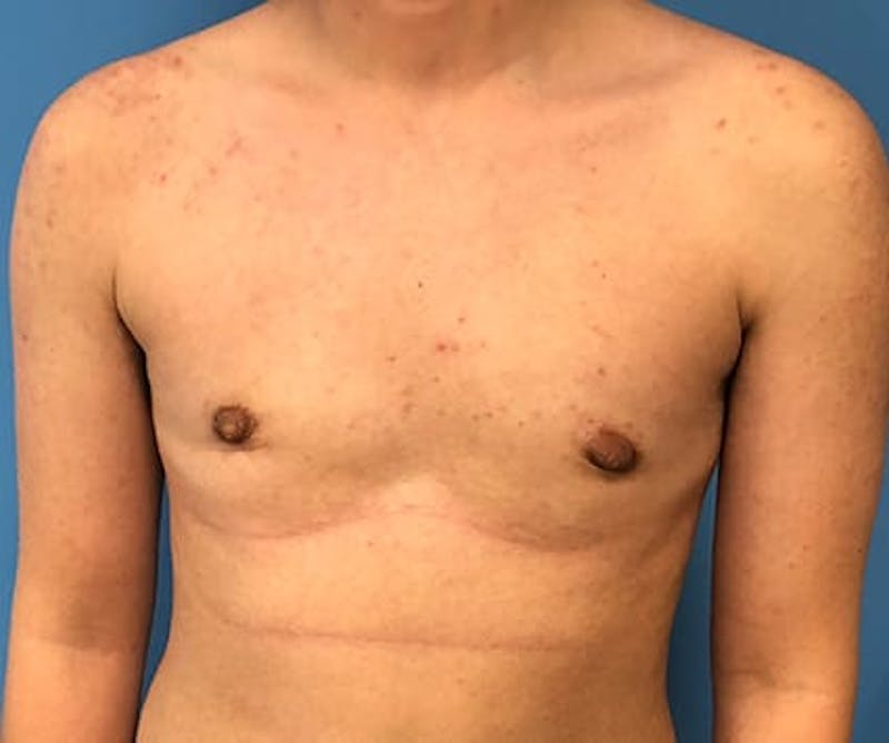 Chest Masculinization Before & After Gallery - Patient 783657 - Image 2