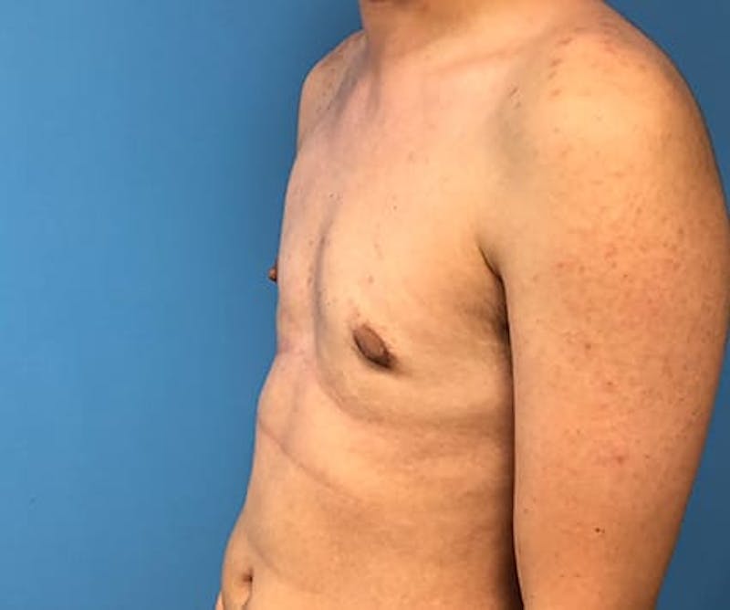 Chest Masculinization Before & After Gallery - Patient 783657 - Image 4