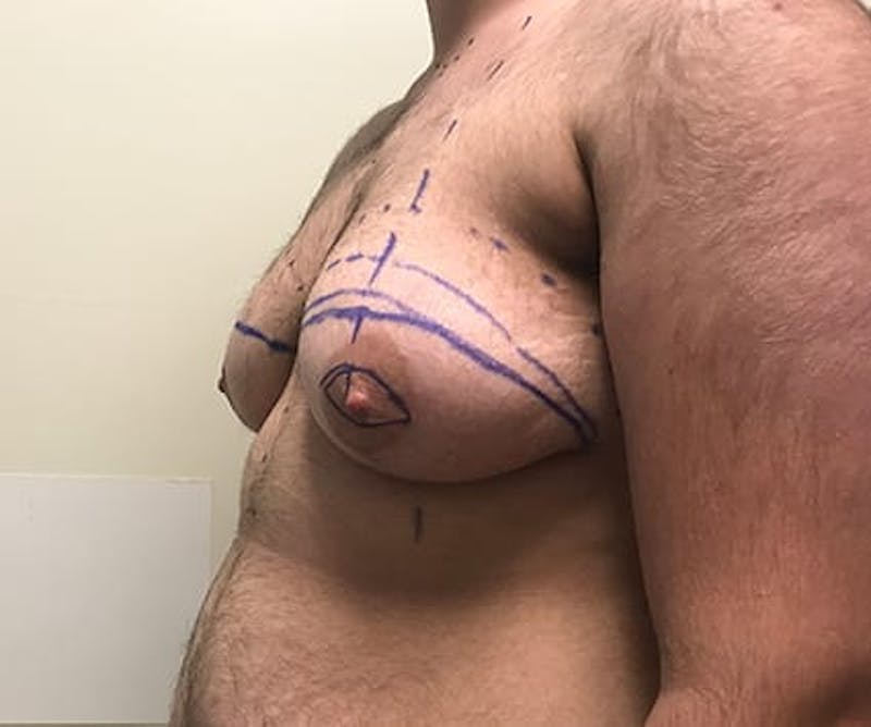 Chest Masculinization Before & After Gallery - Patient 202664 - Image 5