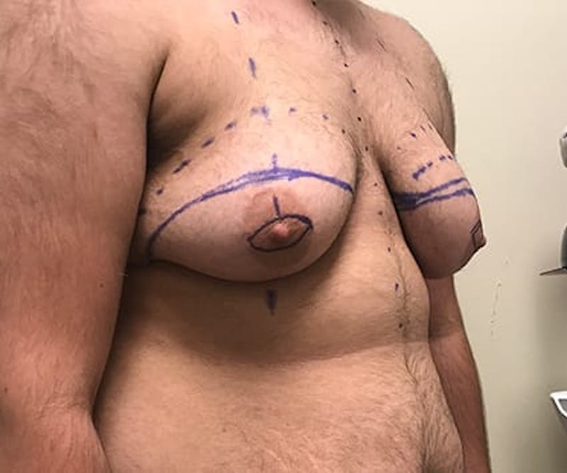 Chest Masculinization Before & After Gallery - Patient 202664 - Image 3