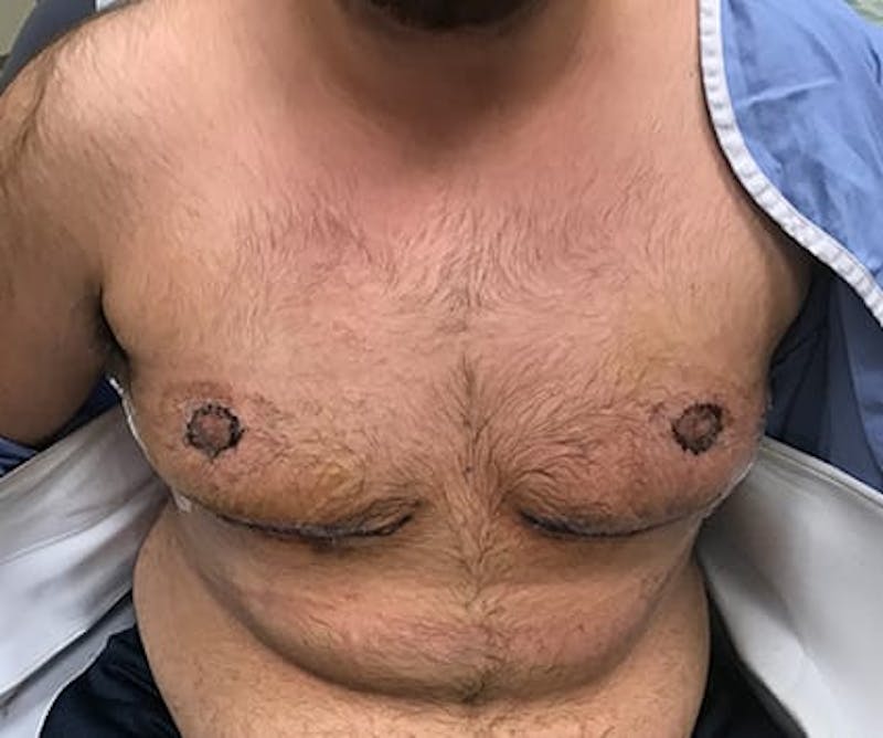 Chest Masculinization Before & After Gallery - Patient 202664 - Image 2