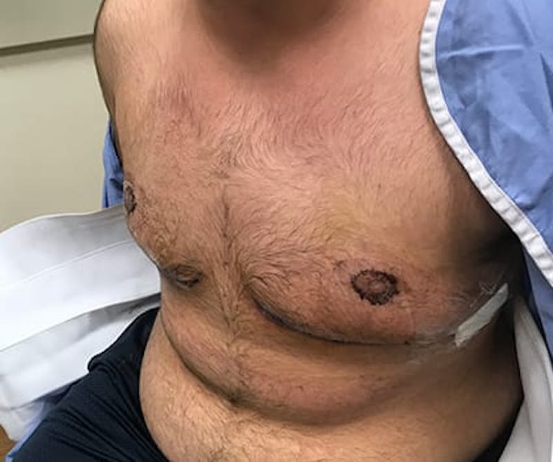 Chest Masculinization Before & After Gallery - Patient 202664 - Image 6