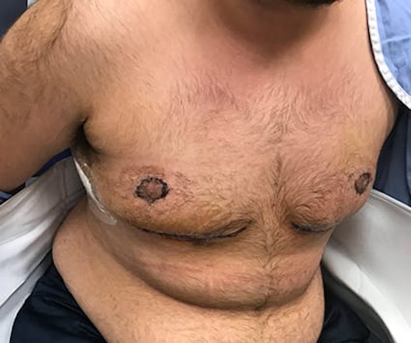 Chest Masculinization Before & After Gallery - Patient 202664 - Image 4