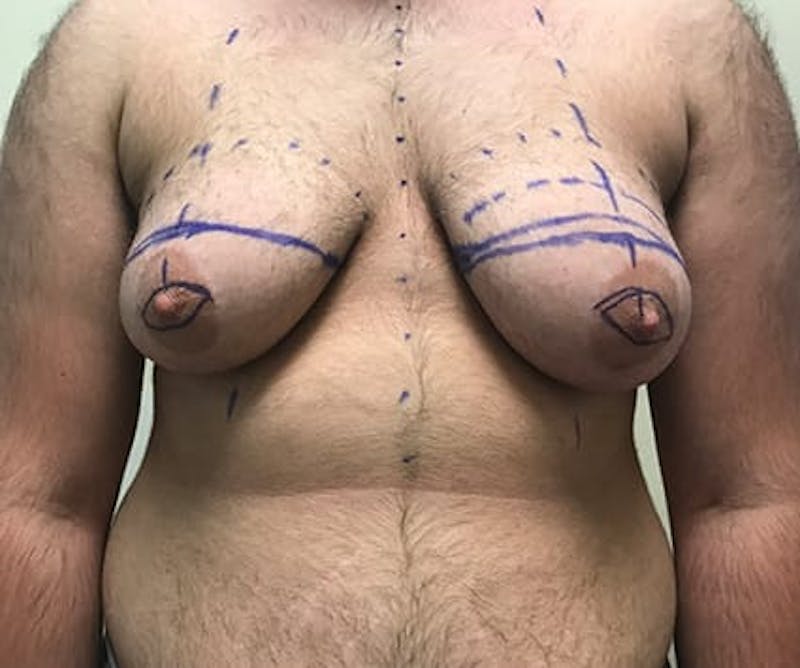 Chest Masculinization Before & After Gallery - Patient 202664 - Image 1