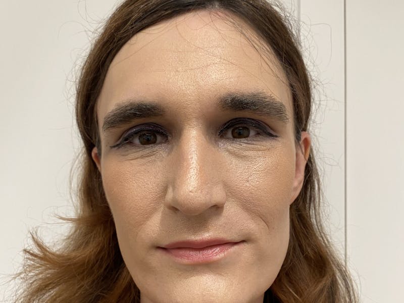 Case Studies Before & After Gallery - Patient 106009 - Image 1