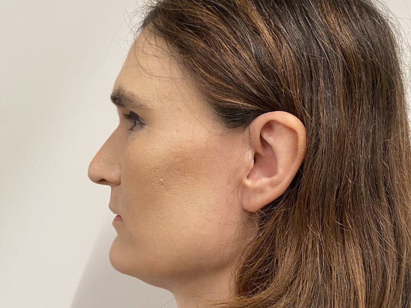 Case Studies Before & After Gallery - Patient 106009 - Image 3