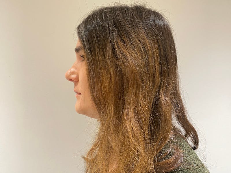 Case Studies Before & After Gallery - Patient 106009 - Image 4