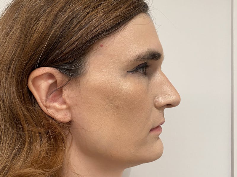 Case Studies Before & After Gallery - Patient 106009 - Image 5