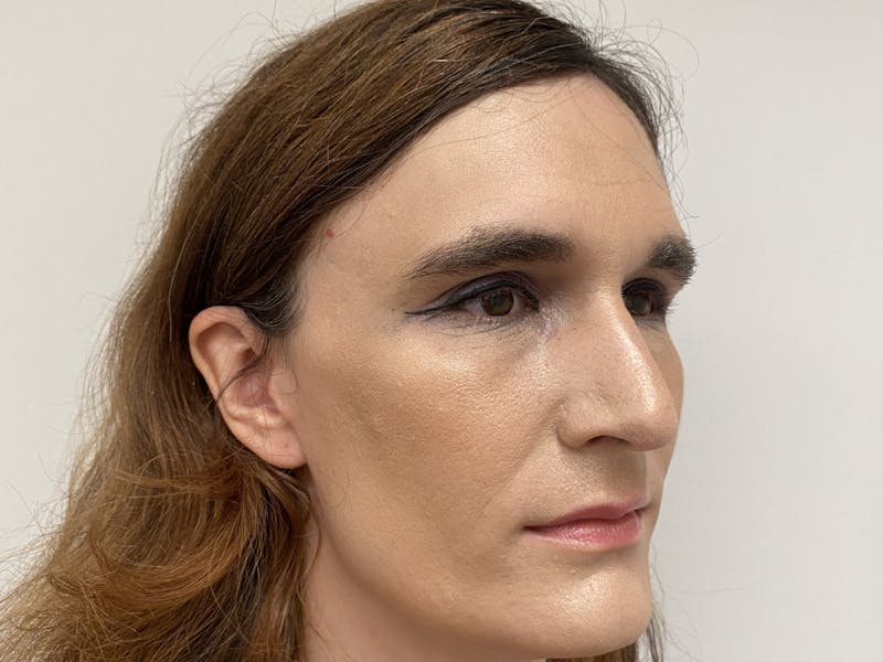 Case Studies Before & After Gallery - Patient 106009 - Image 7