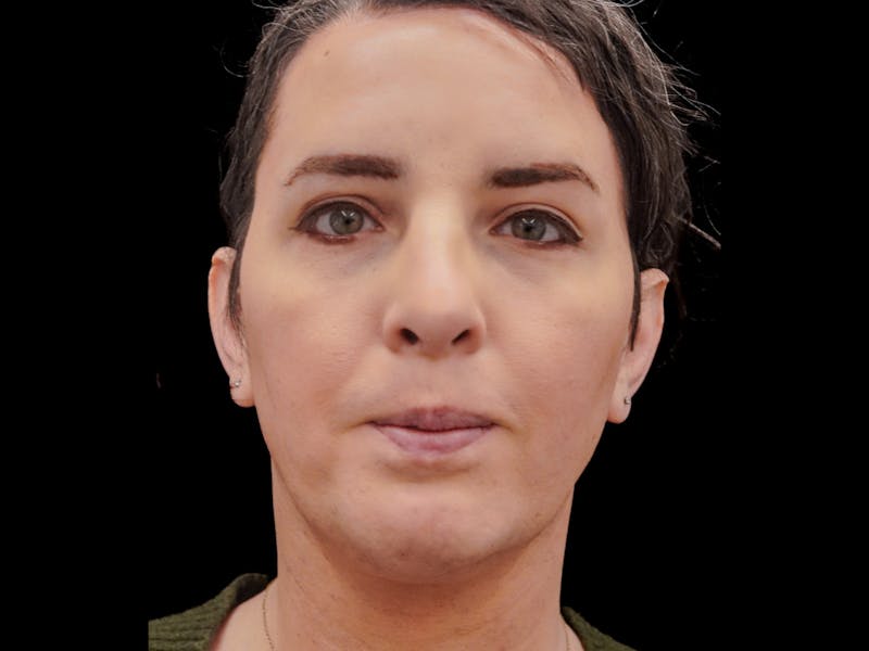 Case Studies Before & After Gallery - Patient 157588 - Image 2