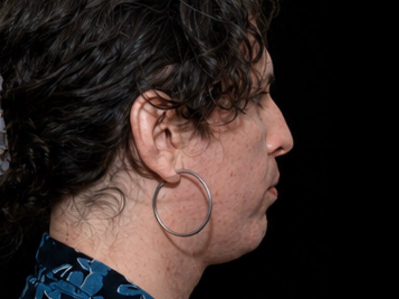 Case Studies Before & After Gallery - Patient 157588 - Image 3