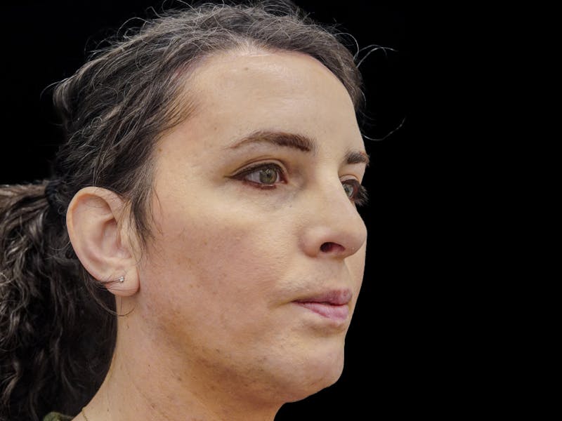 Case Studies Before & After Gallery - Patient 157588 - Image 6