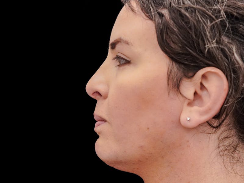 Case Studies Before & After Gallery - Patient 157588 - Image 8